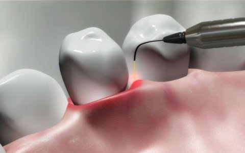 laser-wisdom-teeth-extraction